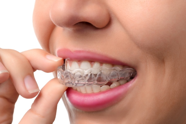 Invisalign Clear Aligners: What Happens After Treatment Is Over