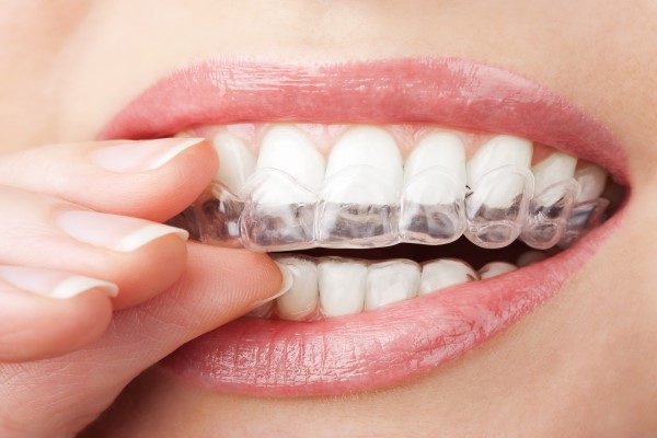 Why Clear Aligners Are More Convenient For Adult Teeth Straightening