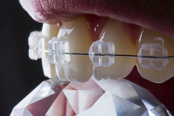 Why You Should Consider Clear Braces