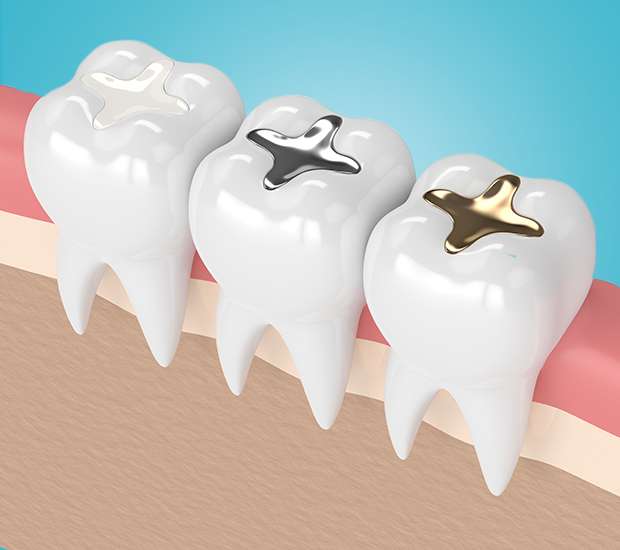 Visalia Composite Fillings