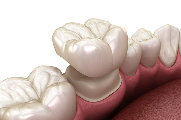 What Can Dental Crowns Do for Your Oral Health Issues? from Visalia Care Dental in Visalia, CA