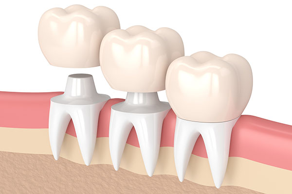 Three Tips to Deal With a Loose Dental Crown from Visalia Care Dental in Visalia, CA