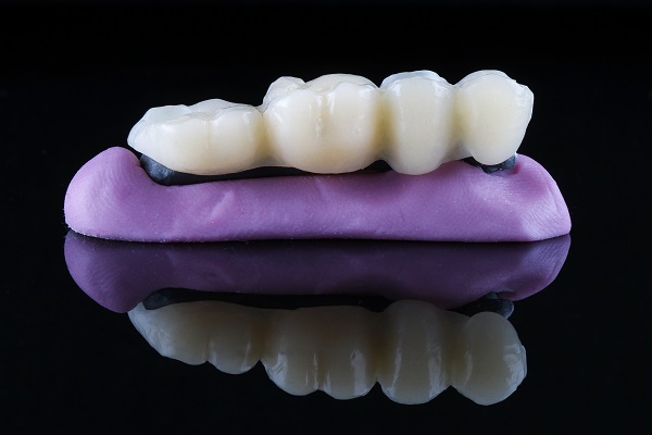 What Is A Dental Bridge?