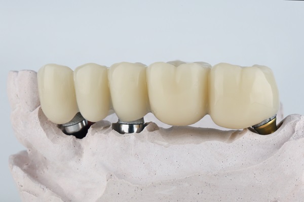 Improve Your Oral Health With A Dental Bridge