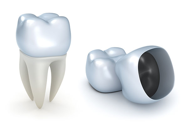 Is a Dental Crown Recommended for Dealing with a Cracked Tooth? from Visalia Care Dental in Visalia, CA