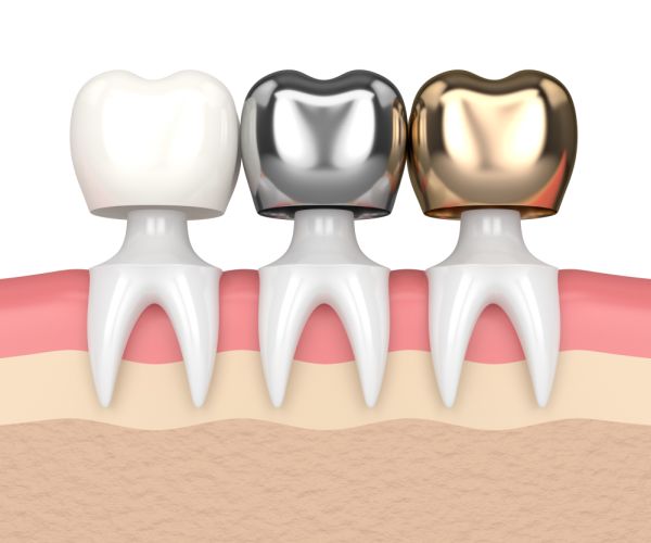 Dental Crowns Visalia, CA