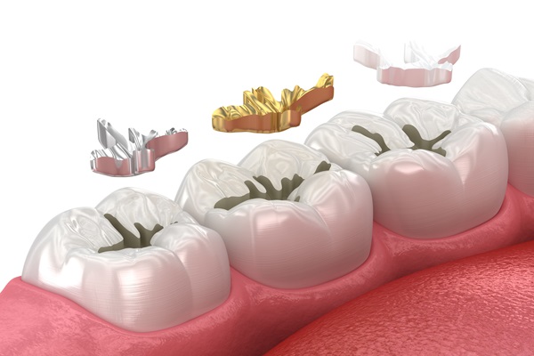 Dental Fillings To Repair A Cracked Tooth