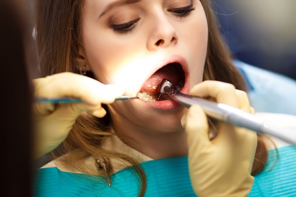 How Long Does A Dental Filling Last?