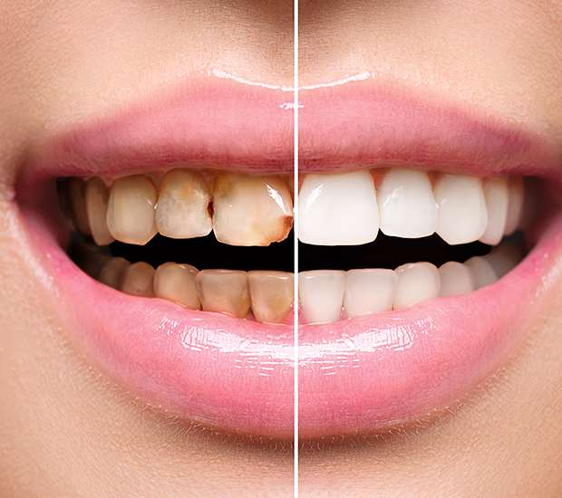 Visalia Dental Implant Restoration