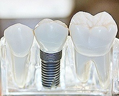Visalia Dental Implant Restoration