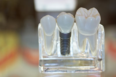 Dental Implant