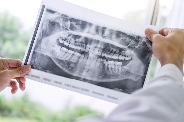 What To Consider When Replacing A Missing Tooth With A Dental Implant