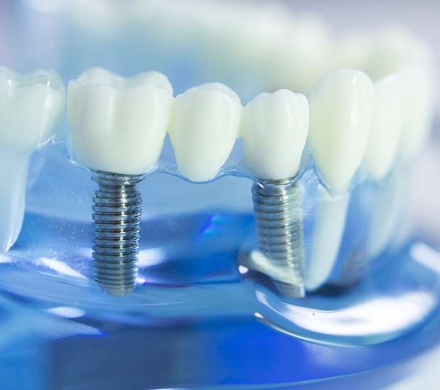 Visalia Dental Implants