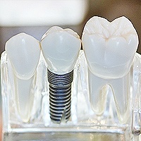 Visalia Dental Implants