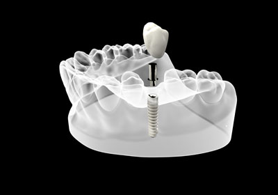 Mini Dental Implants