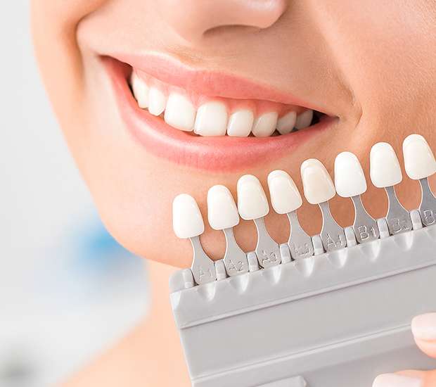 Visalia Dental Veneers and Dental Laminates