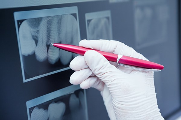 Getting Digital X-Rays From a General Dentist from Visalia Care Dental in Visalia, CA