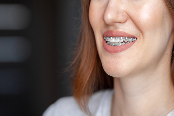Tips From A General Dentist On How To Take Care Of Teeth With Braces