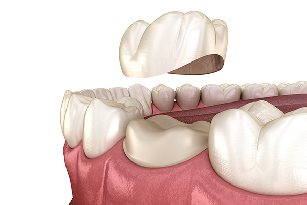 A General Dentist Answers Questions About Dental Crown Material Options from Visalia Care Dental in Visalia, CA