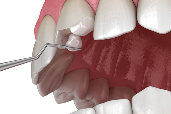 How a General Dentist May Treat a Broken Tooth from Visalia Care Dental in Visalia, CA