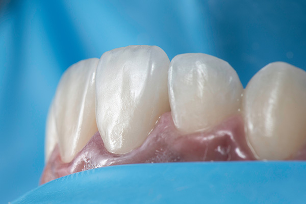 When a General Dentist May Suggest Dental Bonding from Visalia Care Dental in Visalia, CA