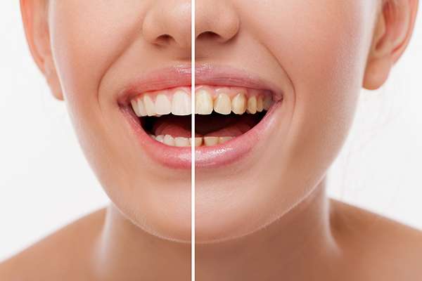 Ask a General Dentist: What Is Restorative Dentistry? from Visalia Care Dental in Visalia, CA