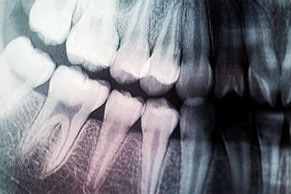 What General Dentistry Exams May Find in an X-Ray Diagnosis from Visalia Care Dental in Visalia, CA