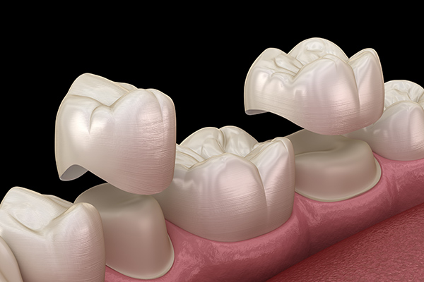 Popular General Dentistry Procedures for Damaged Teeth: Dental Crowns from Visalia Care Dental in Visalia, CA