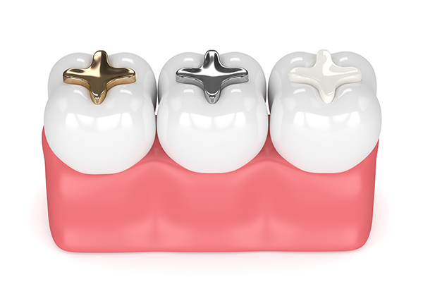 General Dentistry Questions: What is a Dental Filling Used for? from Visalia Care Dental in Visalia, CA