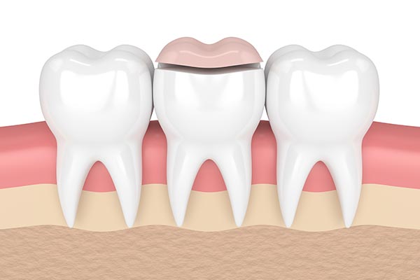 How a Cosmetic Dentist Can Place Inlays and Onlays from Visalia Care Dental in Visalia, CA