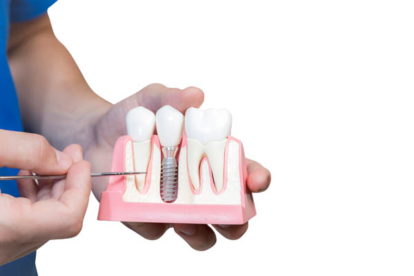 Implant Dentist Visalia, CA