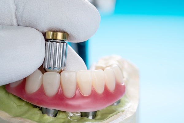 A Brief Comparison Between Implant Supported Dentures And Traditional Dentures
