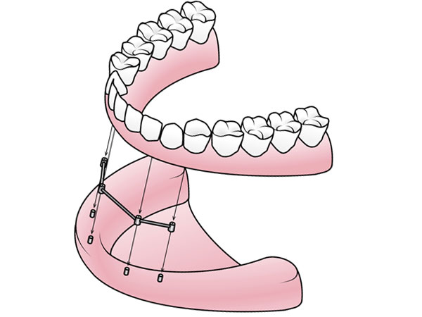 Visalia Implant Supported Dentures