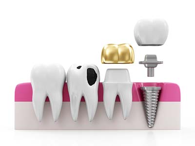 Find Out How Dental Prosthetics Can Replace Your Missing Teeth