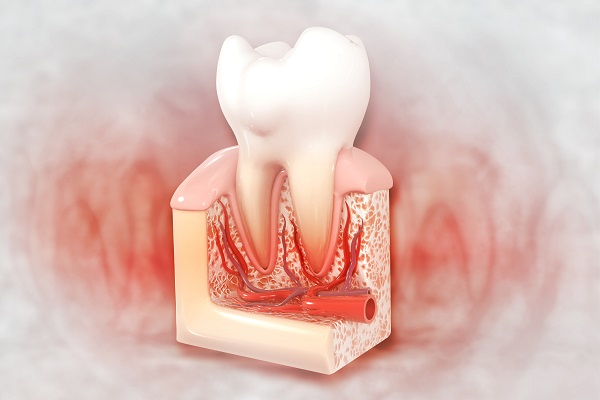 Can Multiple Teeth Need A Root Canal?