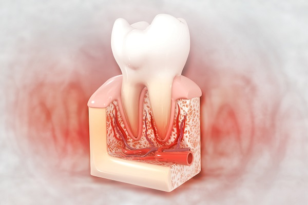 tooth that needs root canal