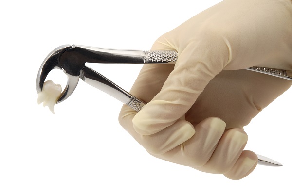 Tooth Extraction Is A Common General Dentistry Procedure